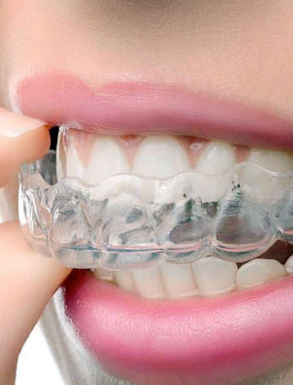 Dental Mouth Guard