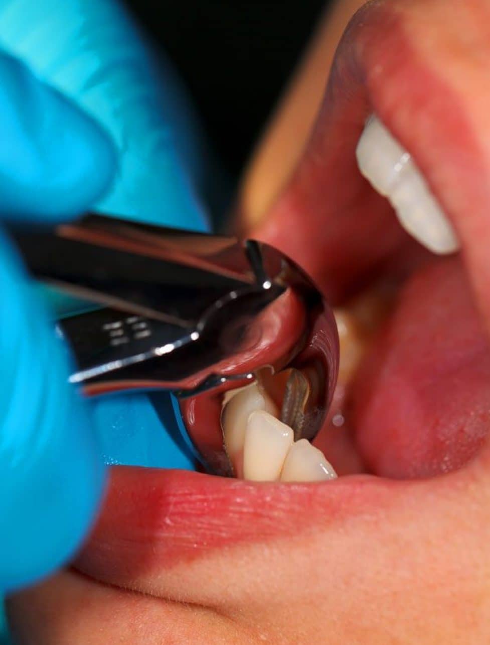 Tooth Extractions